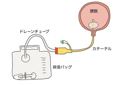 カテーテル留置について 【説明】